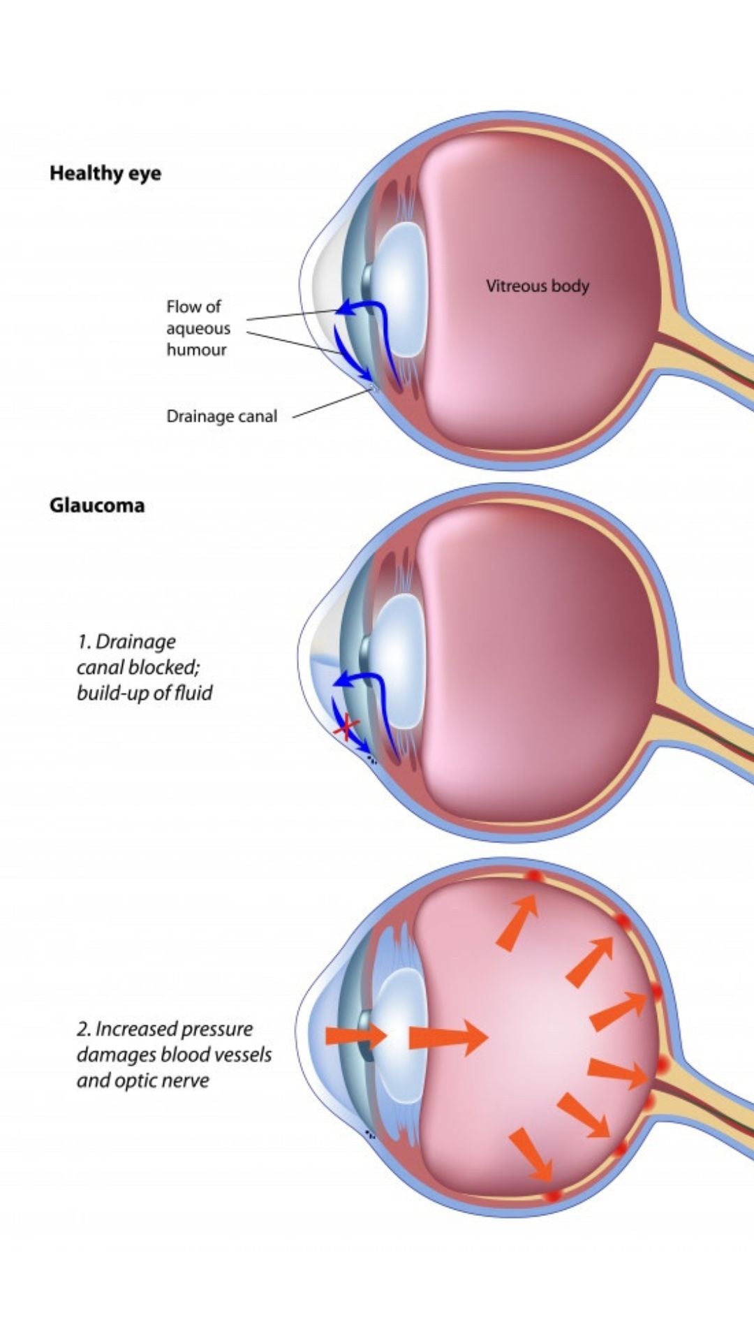 Glaucoma_development_OCULA