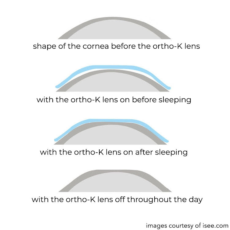 orthok-OCULA