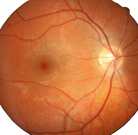 retinal photograhy