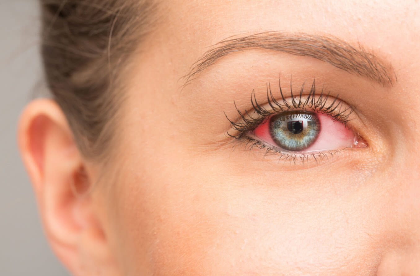 Dry eye symptoms & treatments OCULA